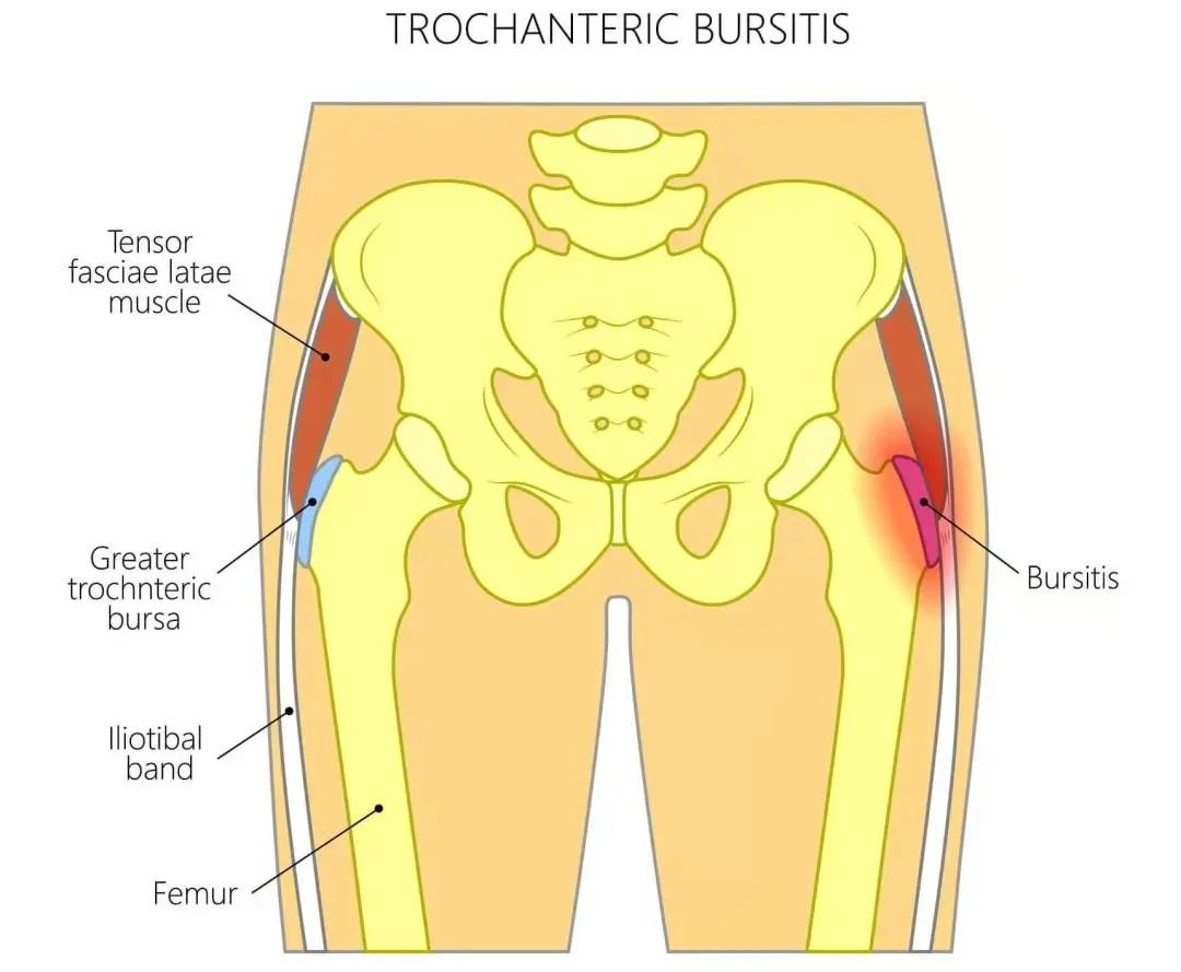 什么是大转子滑囊炎?出现臀部外侧的5种疼痛,需提高警惕