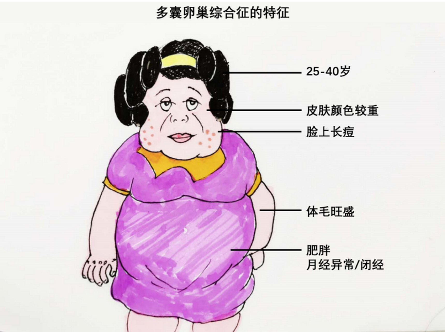 卵巢多囊病是什么_卵巢多囊病是什么症状