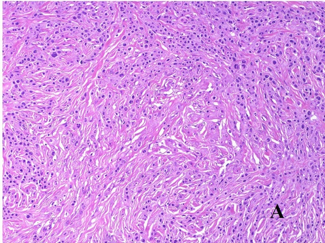 头颈部病理十大-促纤维增生性恶性黑色素瘤十大鉴别(二)