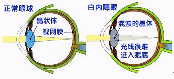 白内障示意图图片