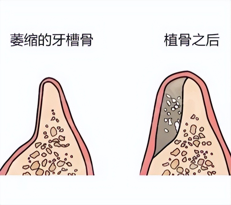 正常填牙骨粉后的图图片