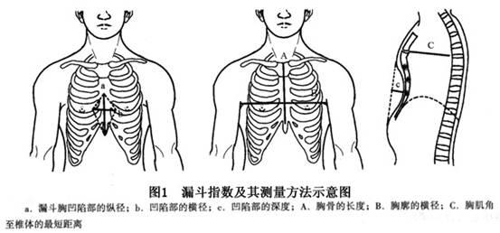宝宝胸前有个坑,咋回事?——鸡胸姊妹篇