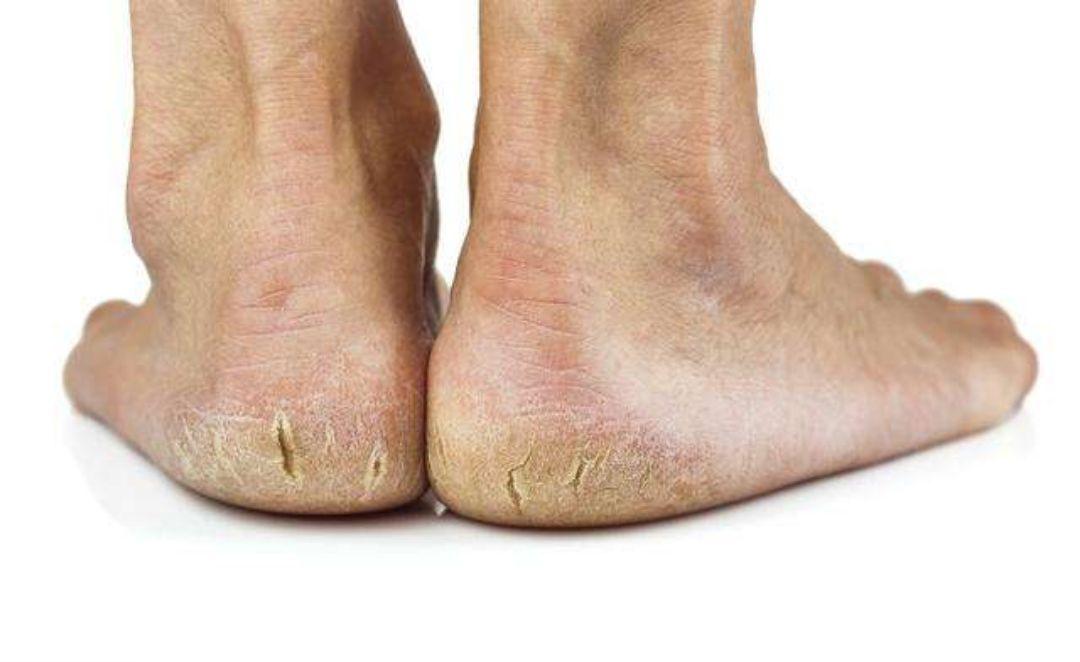 脚后跟干裂,或许并非是皮肤缺水所致,医生告诉你答案,建议了解