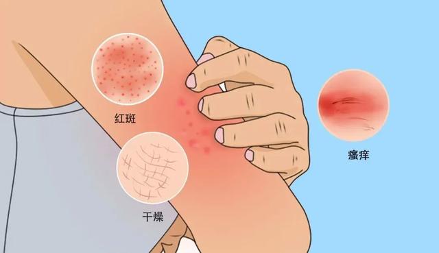 硫辛酸片:糖尿病友皮肤瘙痒怎么办?分享几种方法快速缓解!