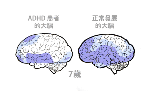 蓝色部分代表大脑皮质发育更成熟区域