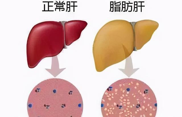 脂肪肝有着不同的分类,人们有怎样的认识?诱发它的因素是什么?