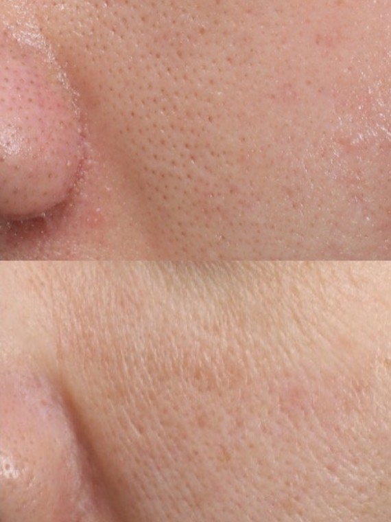 毛孔粗大有黑头怎么办 #医美科普挑战赛#   面对毛孔粗大的问题,我们