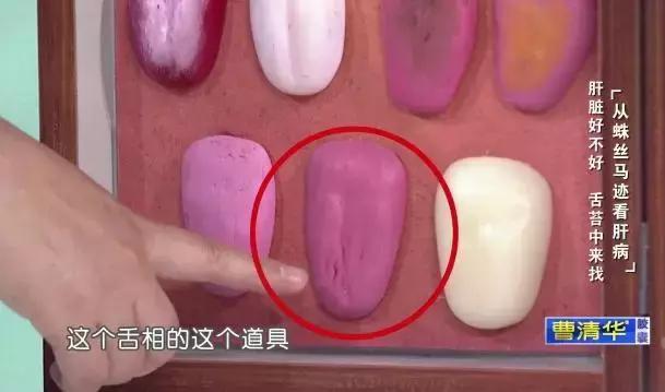 通常是急性肝炎的表现,比如急性的甲肝,戊肝等.