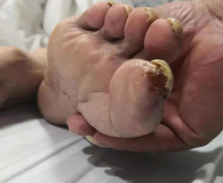 多少个夜里被 老烂脚 疼醒 这样的疾病该如何治疗 医院汇 丁香园