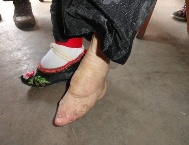 中国最后一位缠足女人,4岁裹脚成三寸金莲,今105岁高龄