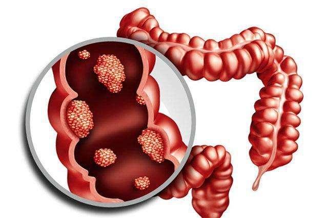 别把肠息肉拖成恶性病,医生:长了肠息肉,身体可能有3种表现