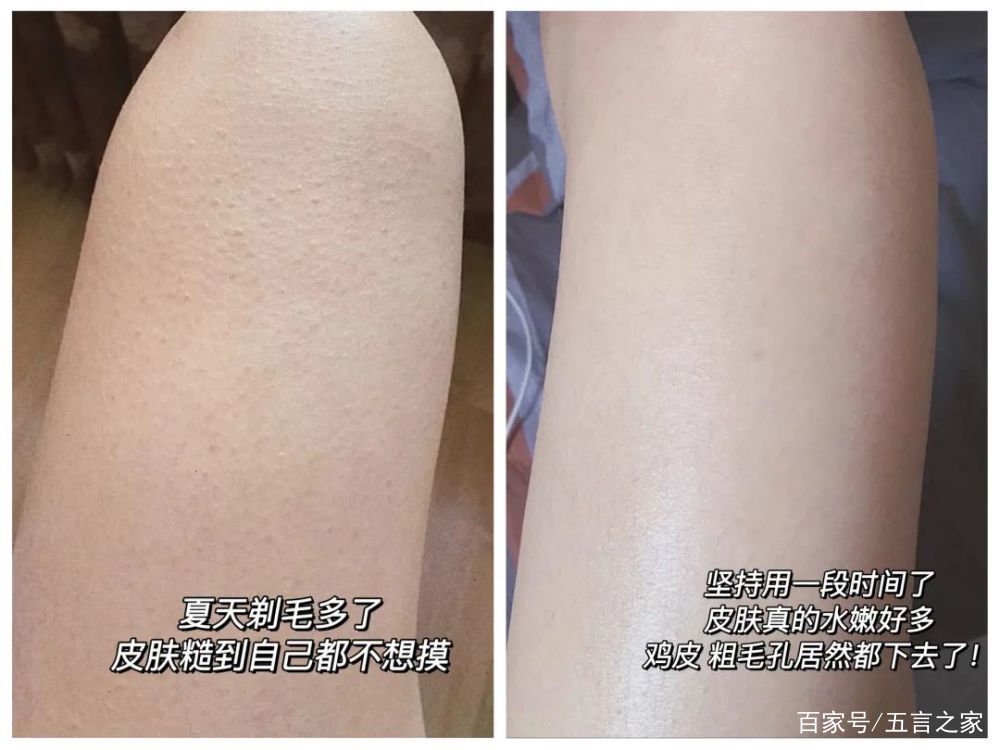 鸡皮肤个紫癜(鸡皮肤是不是病)