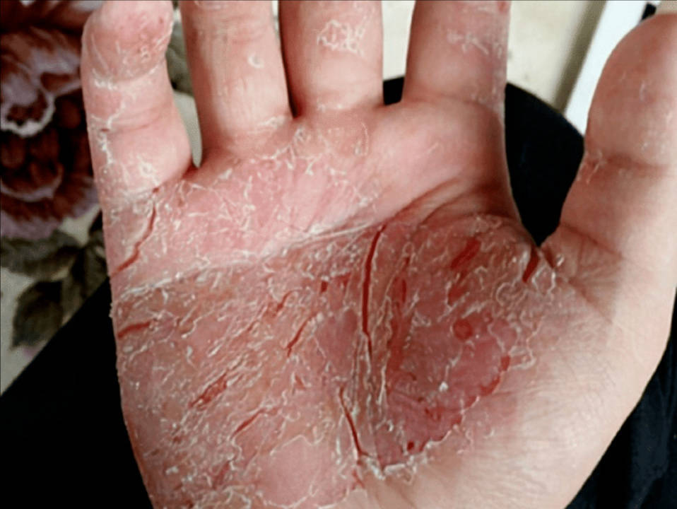 满手干裂一擦就没!过来人首次分享解决攻略,方法简单一看就会!