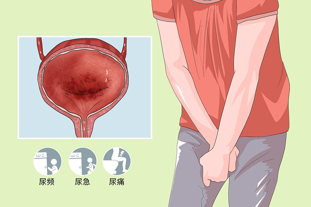 赖特综合征多见于青年男性,病因尚不清楚,起病较急,要引起重视