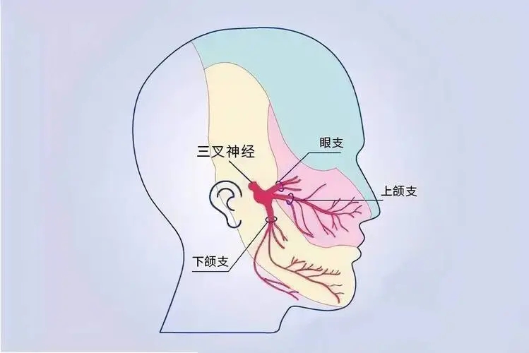 三叉神经痛