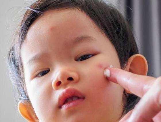 为什么宝宝更容易螨虫过敏?