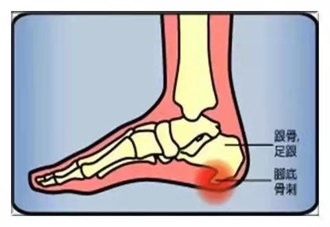 足底筋膜炎导致足跟痛怎么办?这个方法你知道吗?