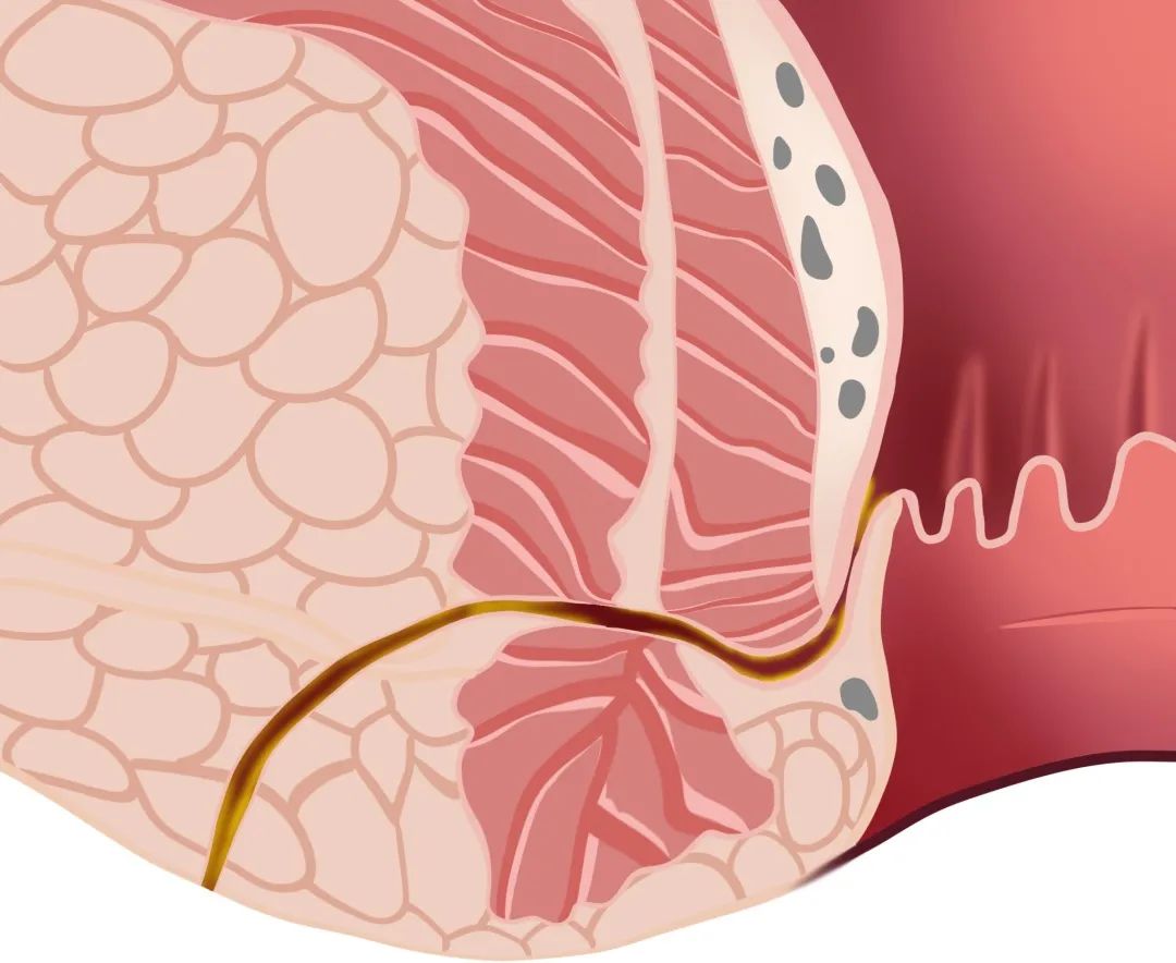 知识科普|肛周脓肿可以保守治疗,但很多人错过这个黄金期