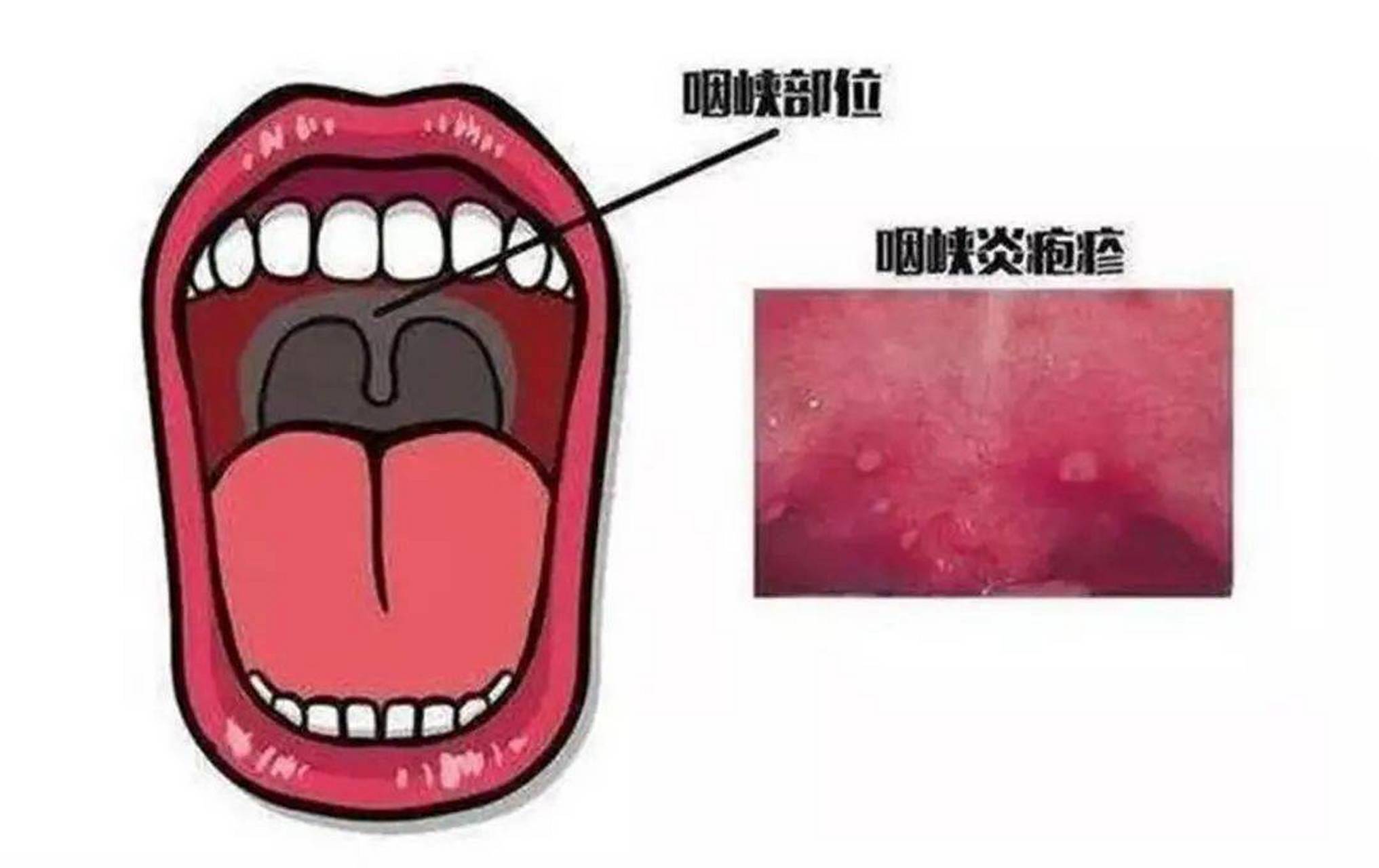 最近家长带着来找我的很多孩子都是"中招"疱疹性咽峡炎的,遇到这种