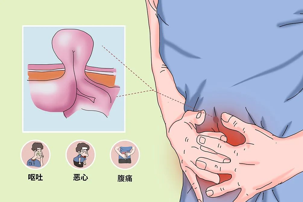 男子健身时肠子掉出来了?专家:发生概率极高