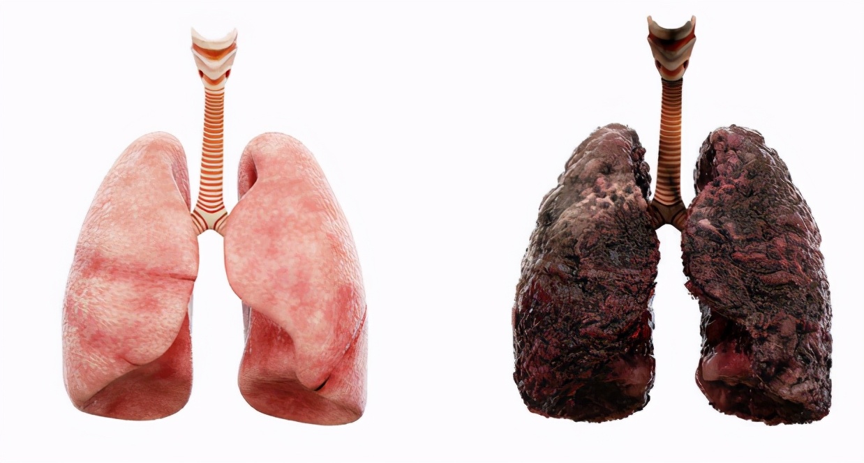 肺病多是"拖"出来的,提醒:身体4种表现莫忽视,尽早检查