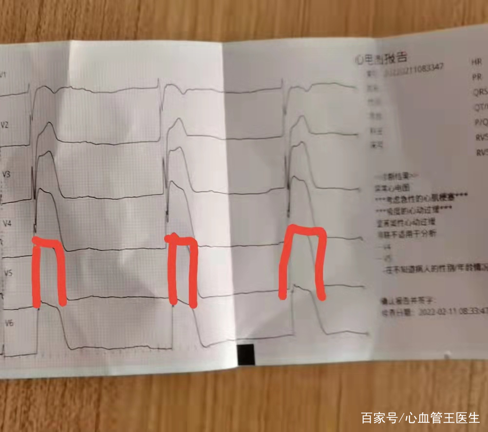 男子心梗，心电图提示：“墓碑样”心电图。还没到医院人就没了！