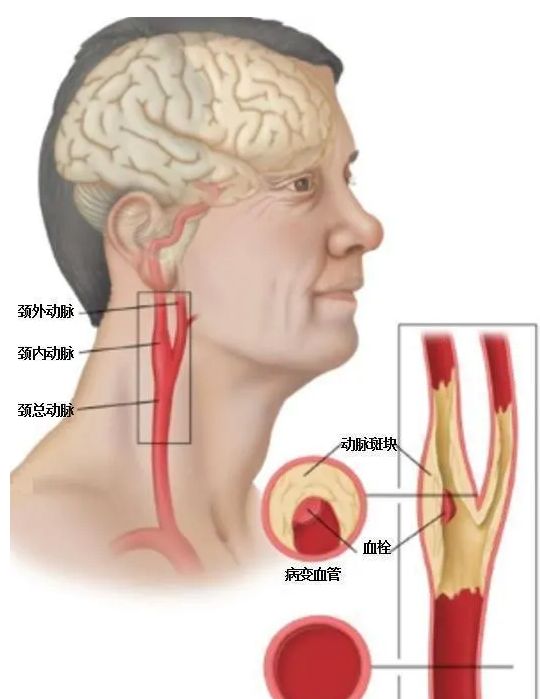 颈动脉斑块图片及说明图片