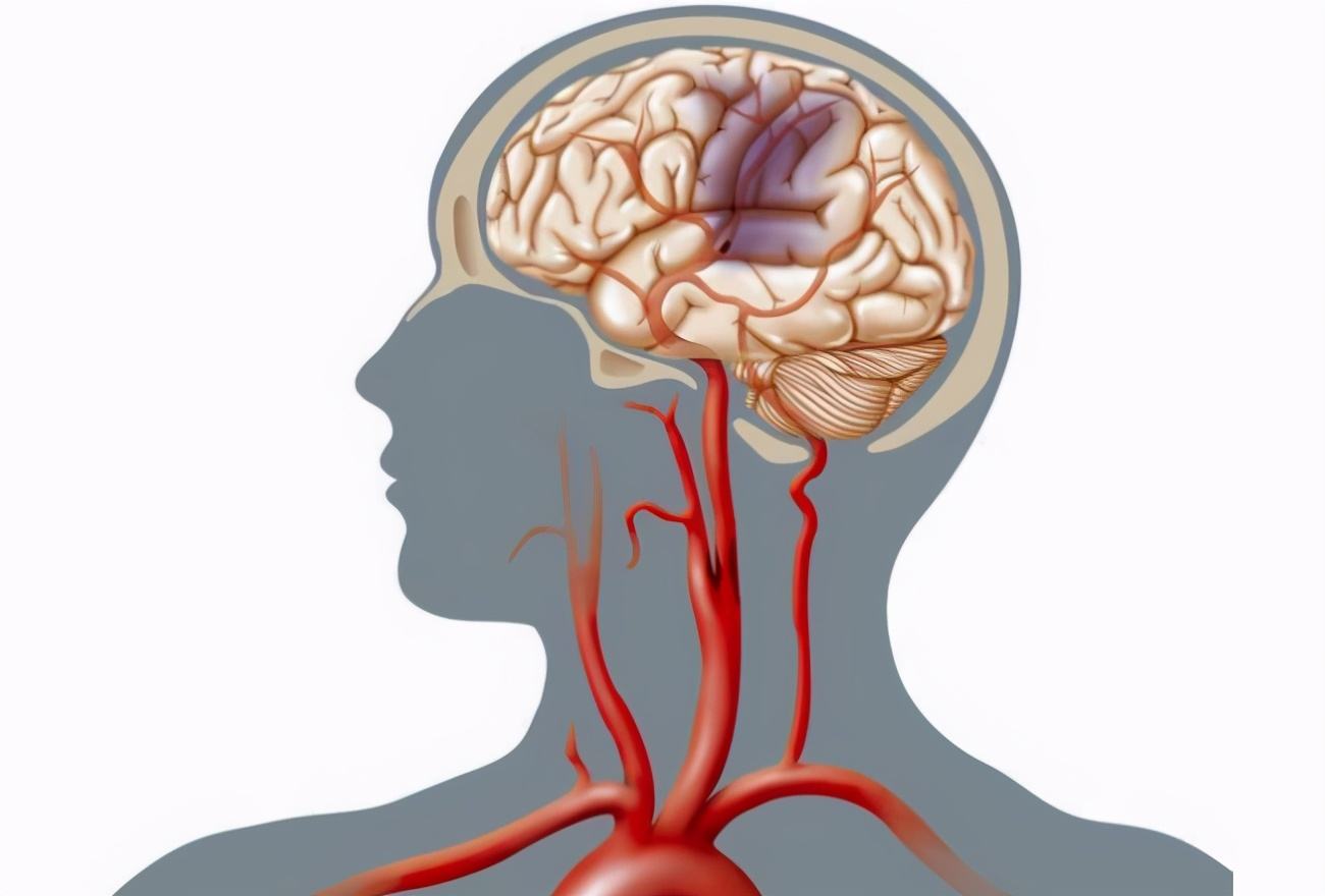 脑梗位置图片图片