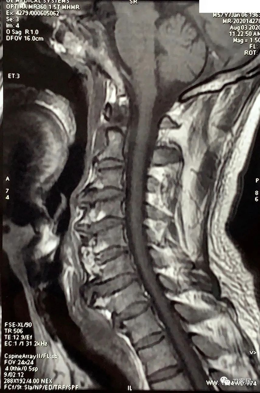 我的门诊病例续:食管型颈椎病?真的有吗?你见过吗?我没见过!