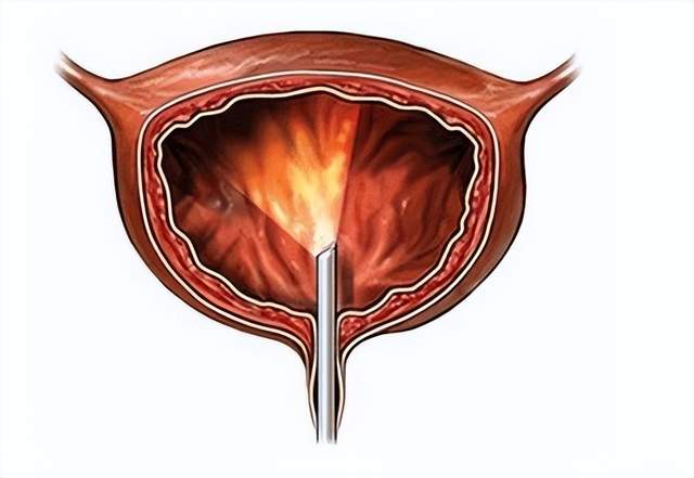 膀胱疼痛的背後隱藏的敵人——間質性膀胱炎?