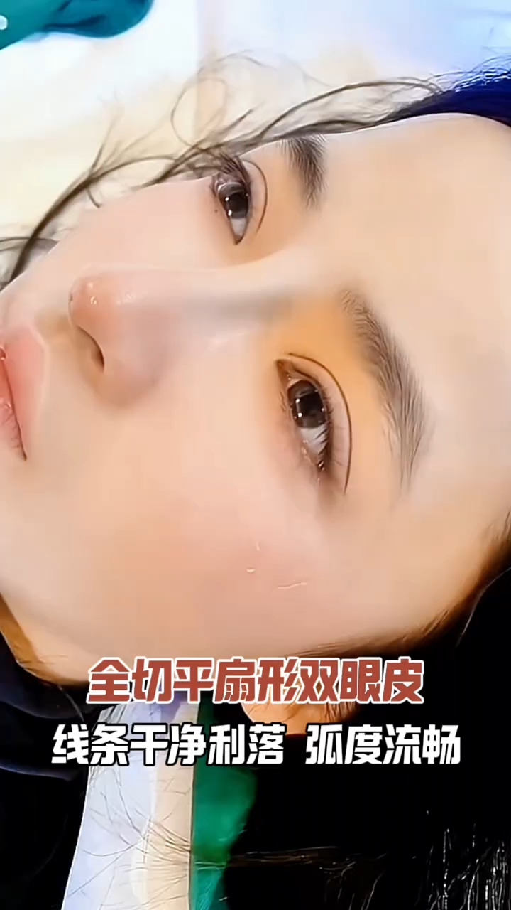 全切双眼皮一个月