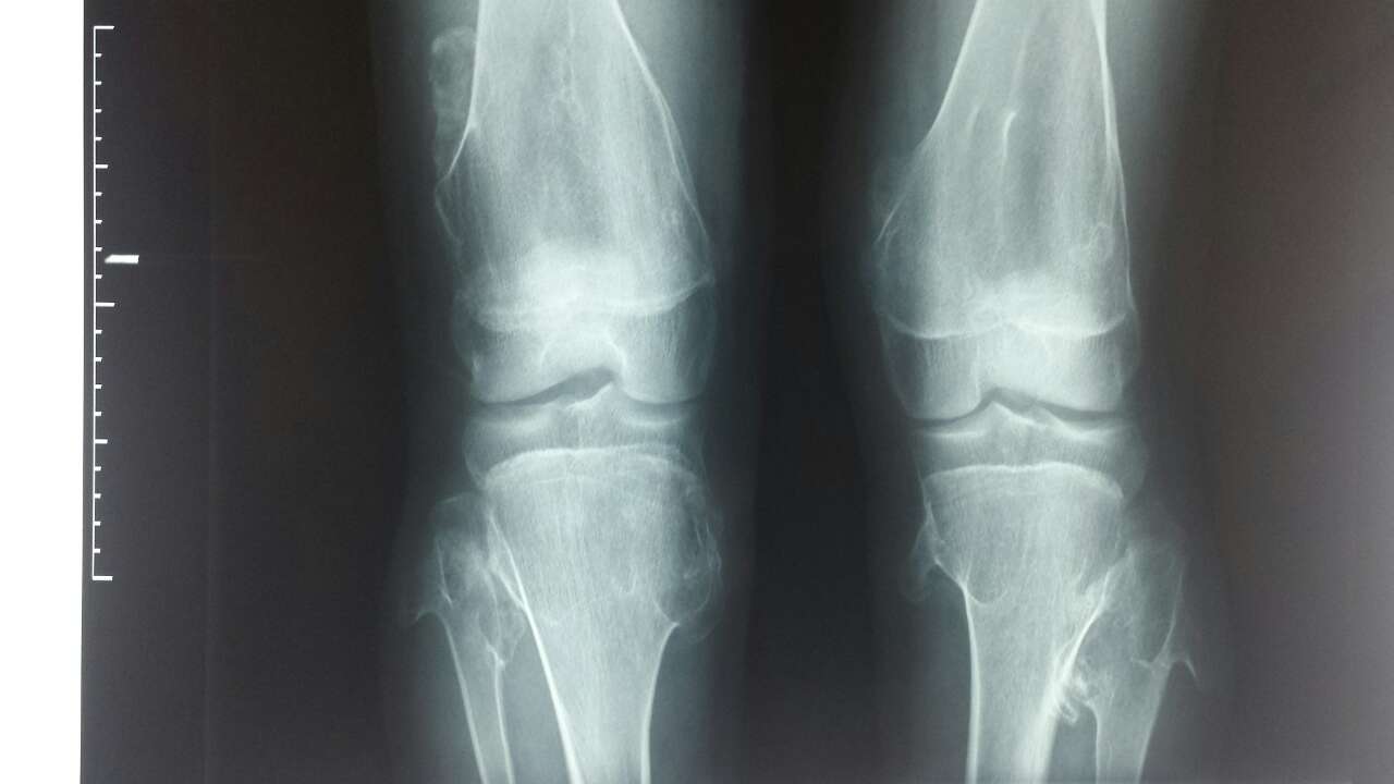 周围性软骨肉瘤治疗方法是广泛性切除,截肢适合肿瘤较大的患者