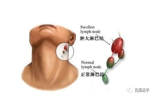 治惡性淋巴瘤及頸部其他腫瘤方