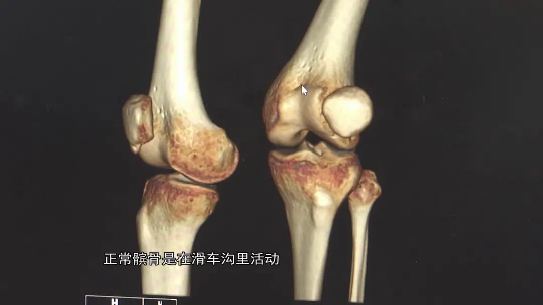 女子因一个动作,致左膝盖骨折!受伤后医生教你如何有效处理