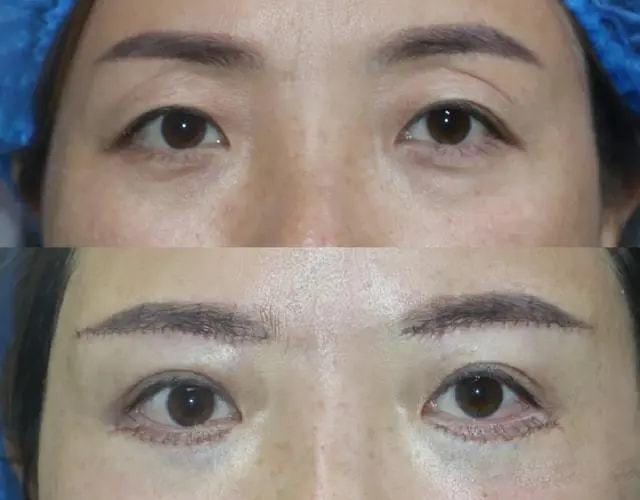 提眉几天能完全消肿,提眉切眼袋后多久能恢复自然?