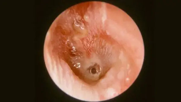 成都民生耳鼻喉医院治疗中耳癌 国家二级专科医院