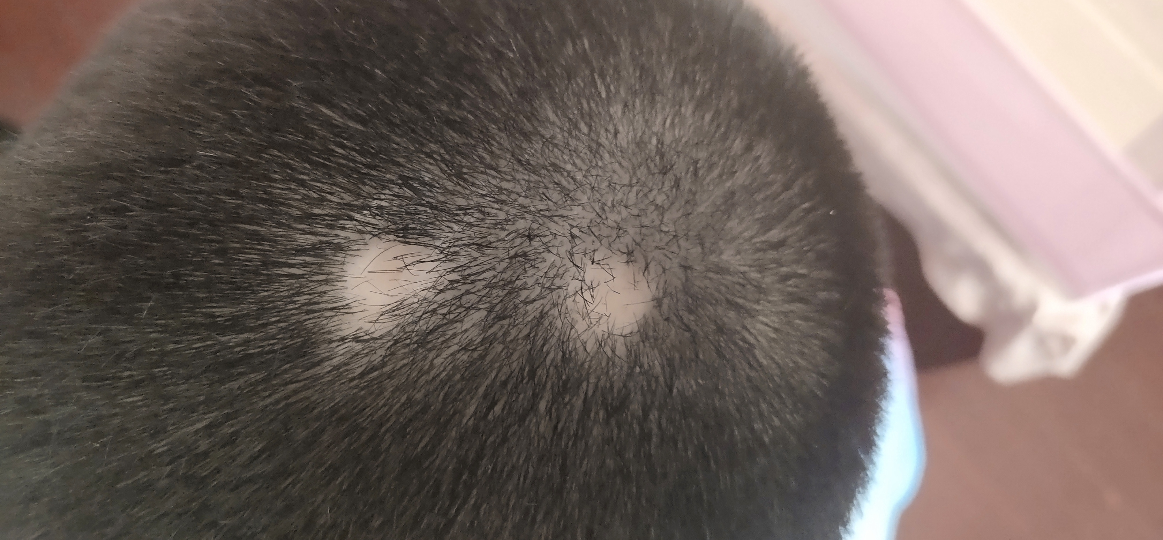 斑秃,又被称之为鬼剃头!