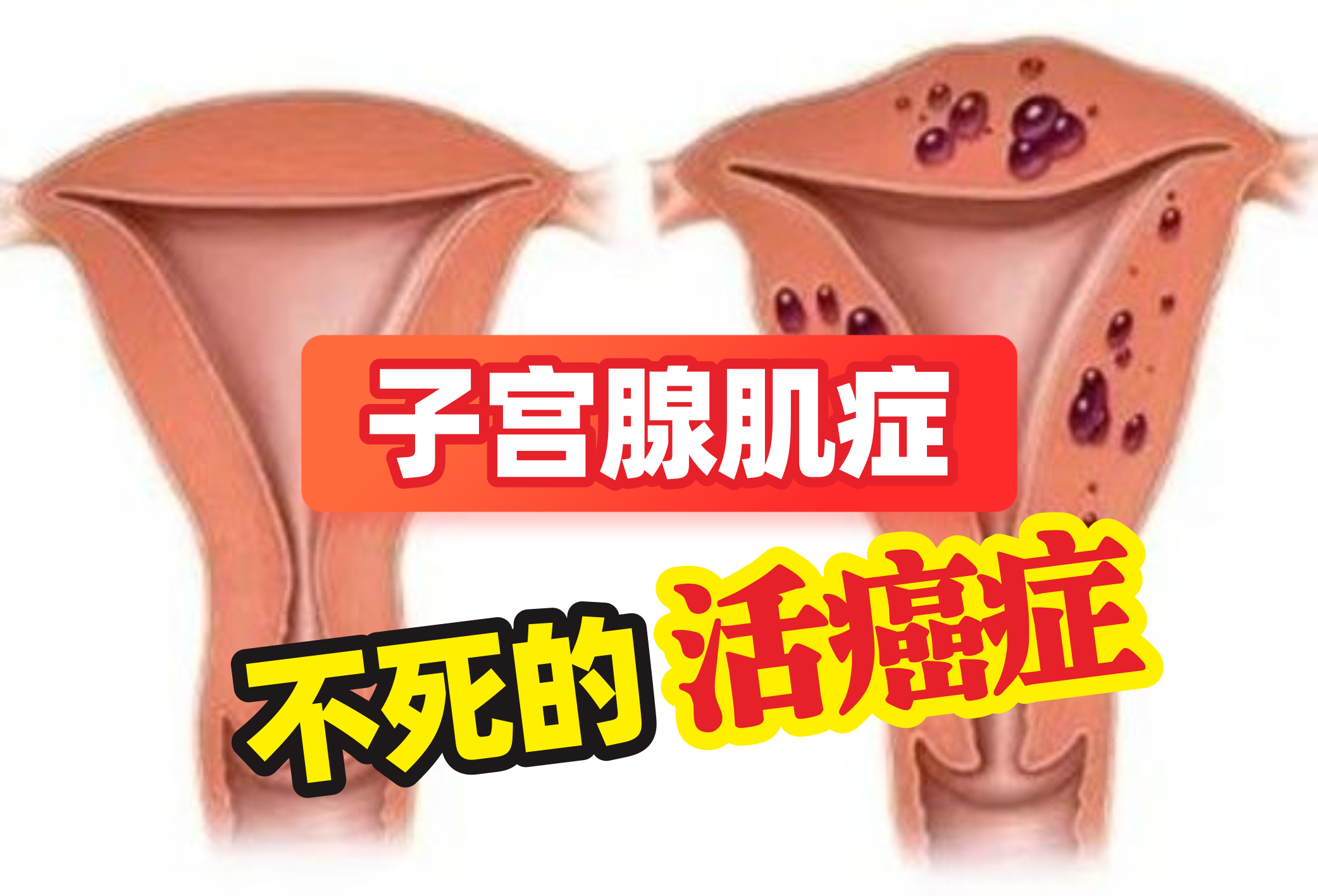 子宫腺肌病不想切子宫如何治疗?这个内服 外敷的方子,请收好!