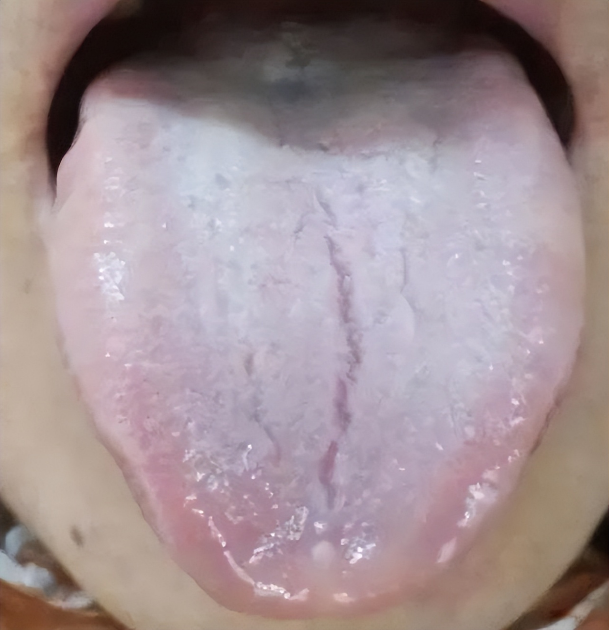 舌头有裂纹是怎么了?教你辨别四种常见裂纹舌,看看你是哪一种?