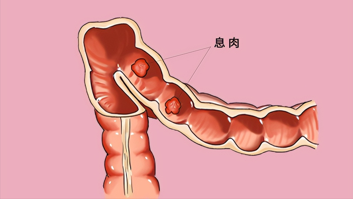 做一次腸鏡,真能保5年沒問題?哪些人群有必要做腸鏡檢查呢?