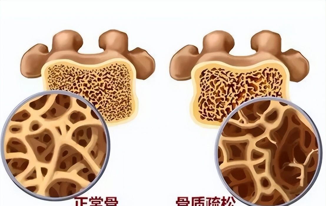 67歲老人骨密度像30,其4種生活方式,多數人都能做