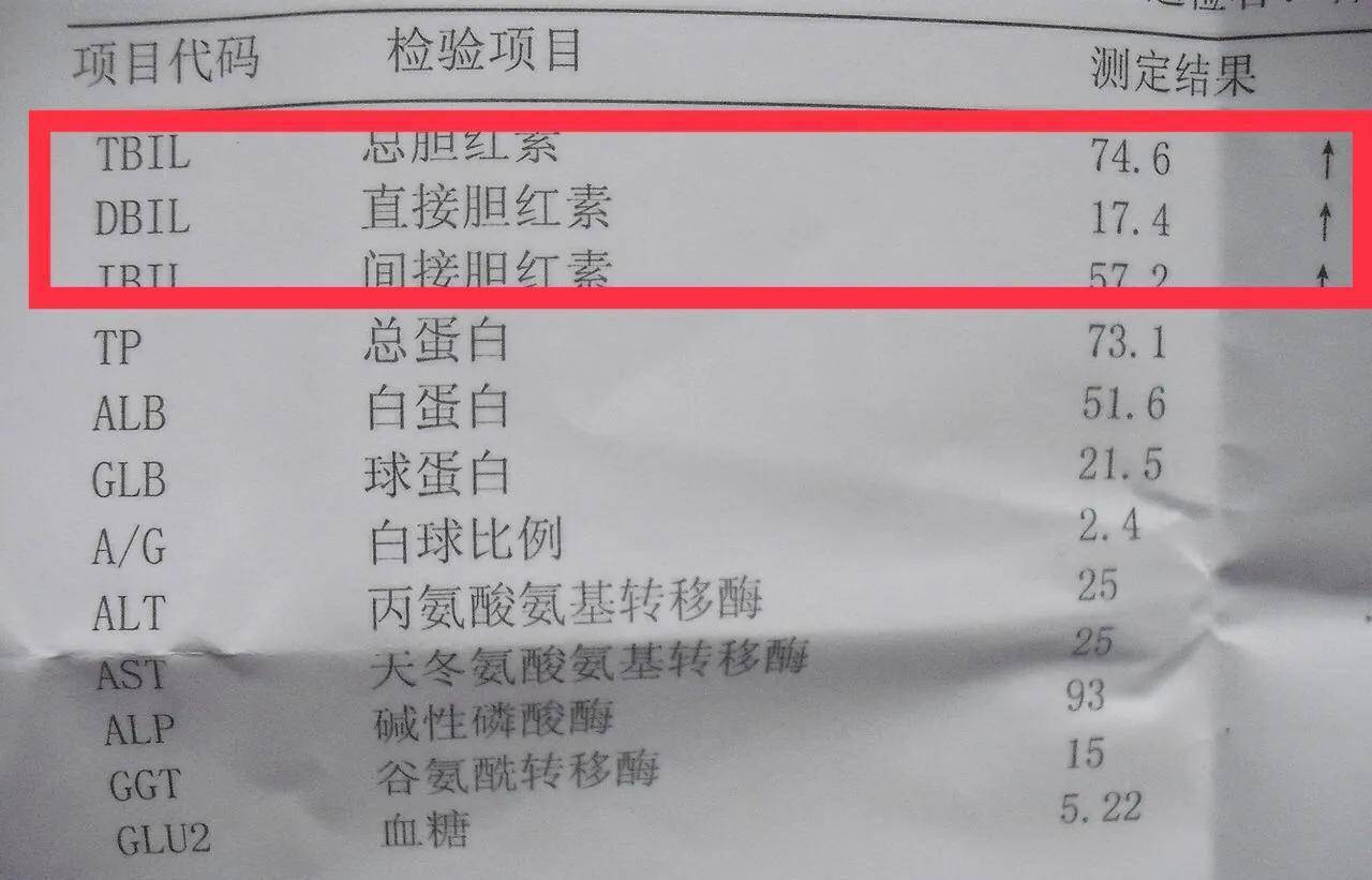 肝功检查,显示单纯胆红素升高,严重吗?学会应对,或能保护肝脏