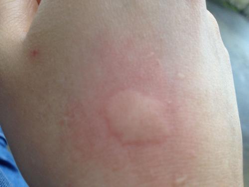 被蚊子咬一下的感觉可以说是非常酸爽了.