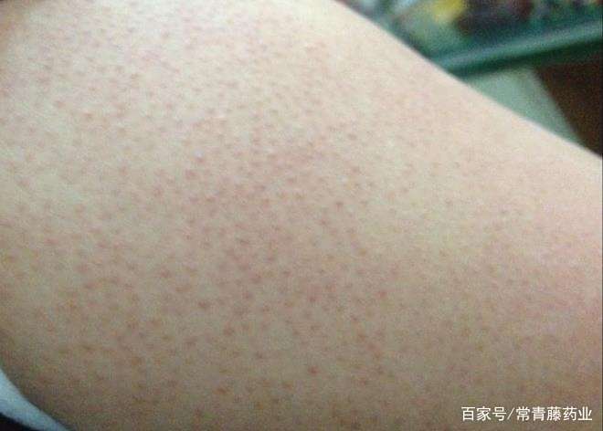 拔罐对鸡皮肤有效果吗(拔罐对鸡皮肤有效果吗视频)