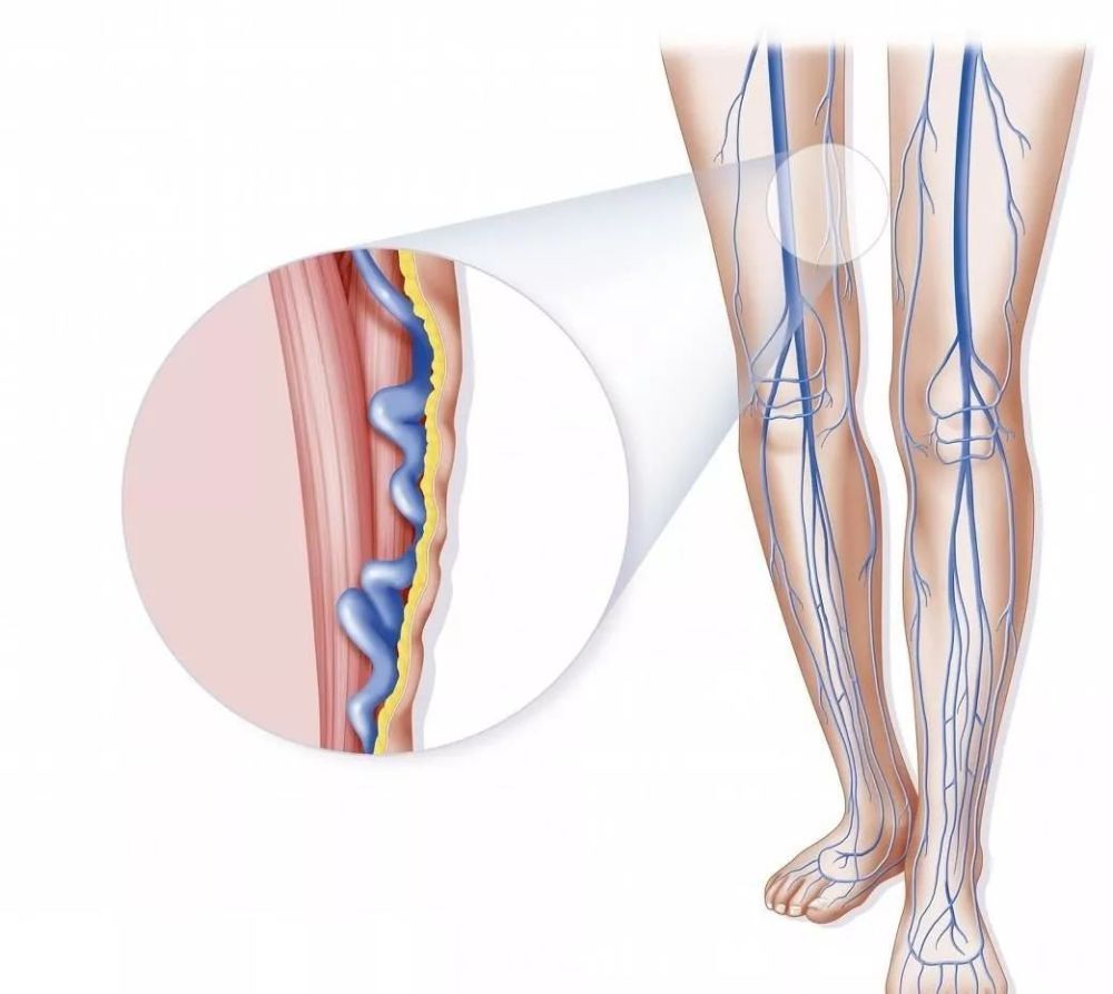 下肢交通静脉瓣膜关闭不全,由于下肢静脉压力增高,与遗传无关