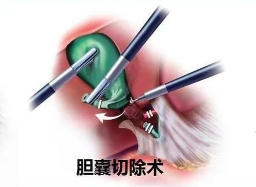 腕踝针在腹腔镜胆囊切除术后患者疼痛干预的效果观察