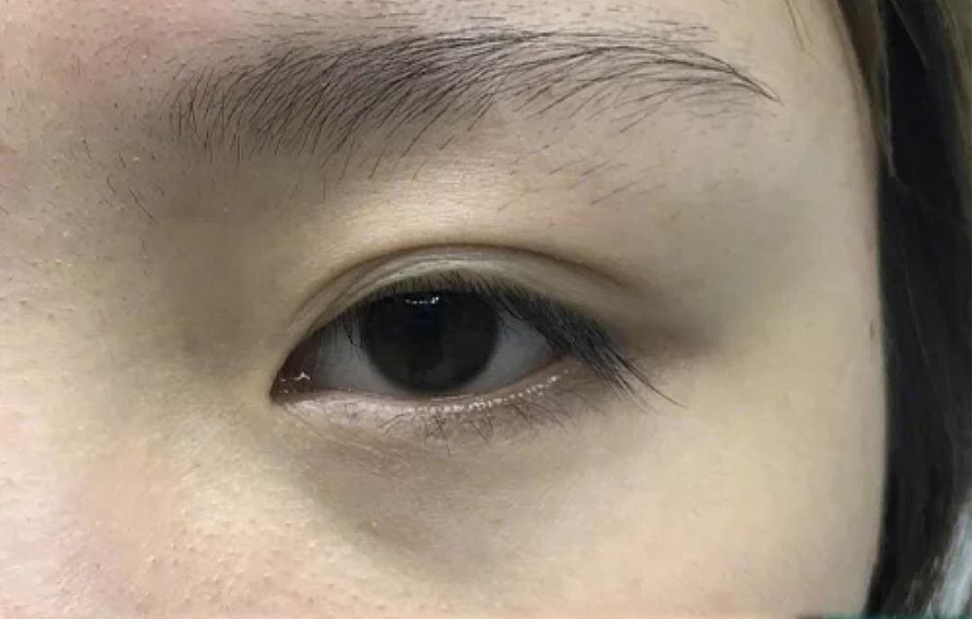 眼修复孙沣博士:双眼皮术后出现分叉能修复吗?