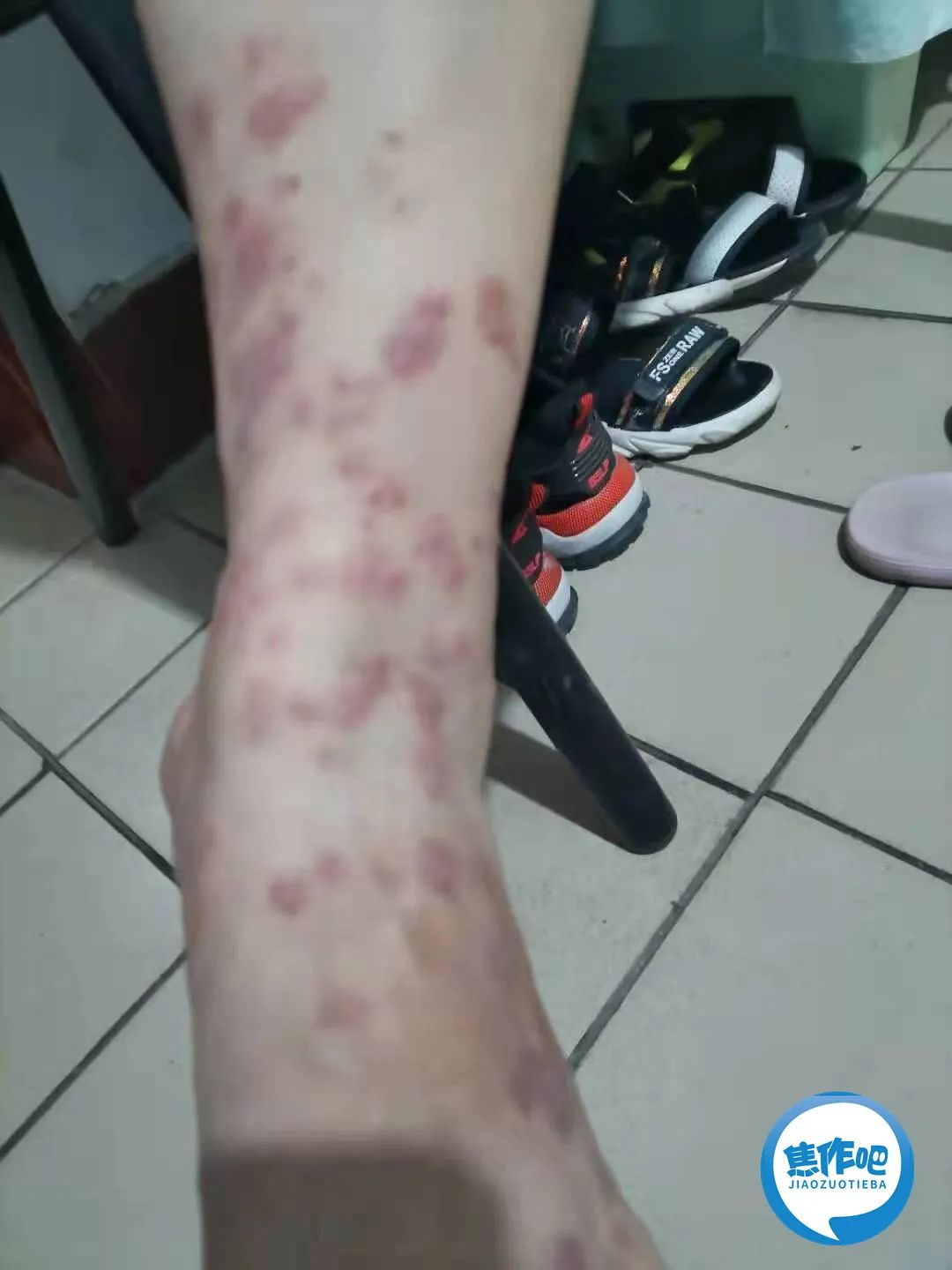 看着都痒!焦作这栋楼被生物攻占!居民都被咬成麻子腿了!