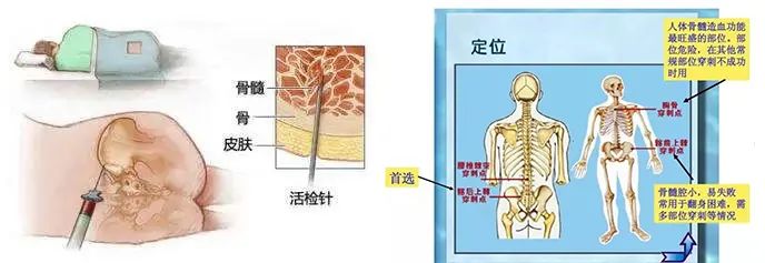 髂后上棘骨穿定位图片