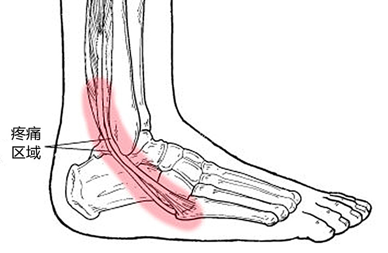 没有崴脚,脚踝外侧却一直疼痛,什么是腓骨肌腱炎?